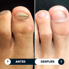 Uñara™ Lápiz Antifungico | 25% Ácido Undecilénico