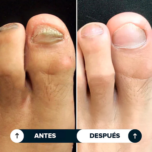 Uñara™ Lápiz Antifungico | 25% Ácido Undecilénico
