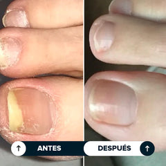 Uñara™ Lápiz Antifungico | 25% Ácido Undecilénico