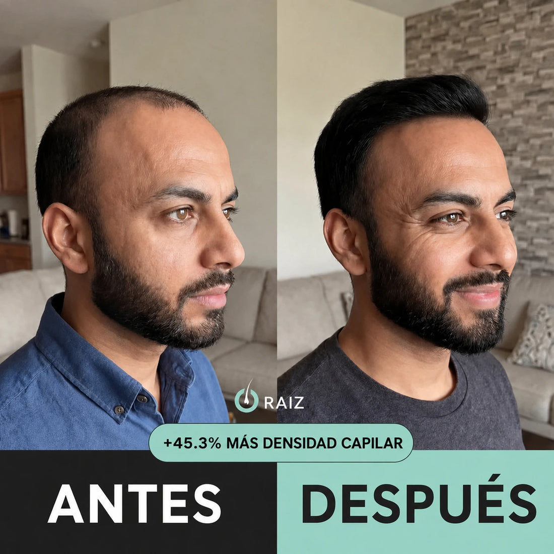 Raíz™ Sistema de Recrecimiento Capilar