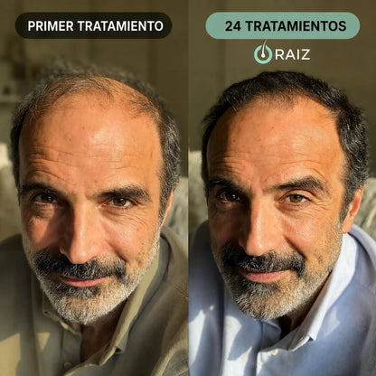 Raíz™ Sistema de Recrecimiento Capilar