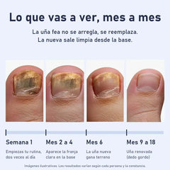 Uñara™ Lápiz Antifungico | 25% Ácido Undecilénico