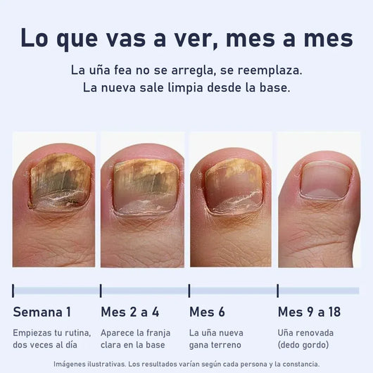 Uñara™ Lápiz Antifungico | 25% Ácido Undecilénico